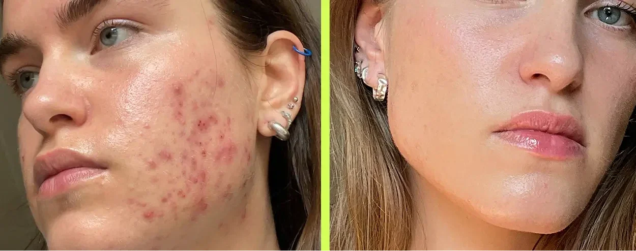 Acné hormonale sur le menton et la mâchoire avant, et une peau apaisée et uniforme après l'approche de l'intérieur