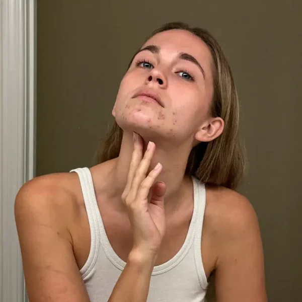 Femme épuisée par des traitements qui ne calment la surface que temporairement